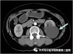 肾囊肿痛了怎么办