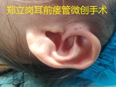 如果耳前瘘管脓肿形成,可以切开排脓,待炎症消退后最好考虑手术切除
