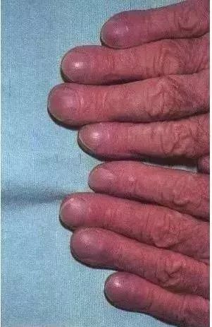 【12551健康】手指如果有这种隆起,一定要小心,可能是肺癌征兆!