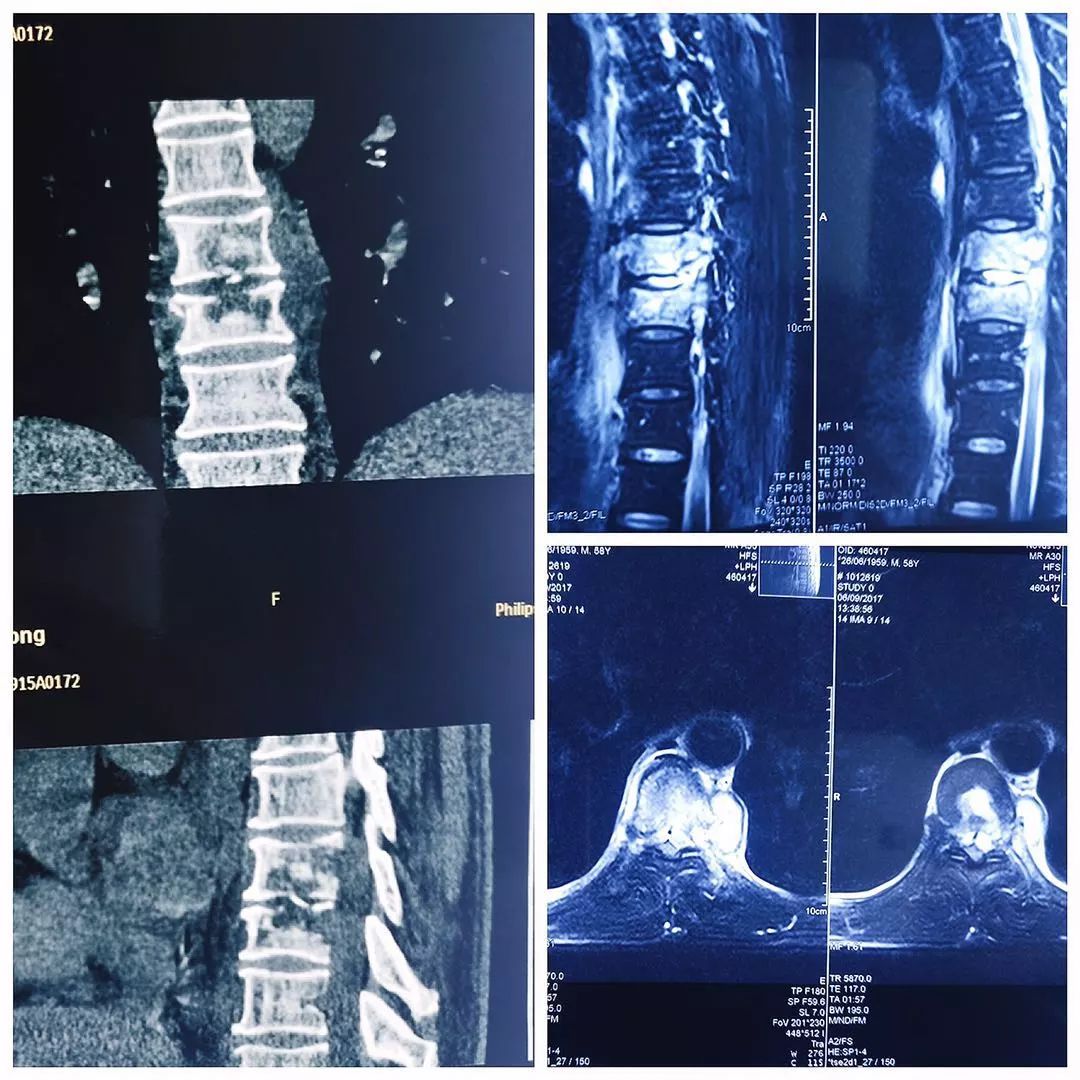 9椎体骨质破坏,信号异常,考虑椎体结核可能性大".