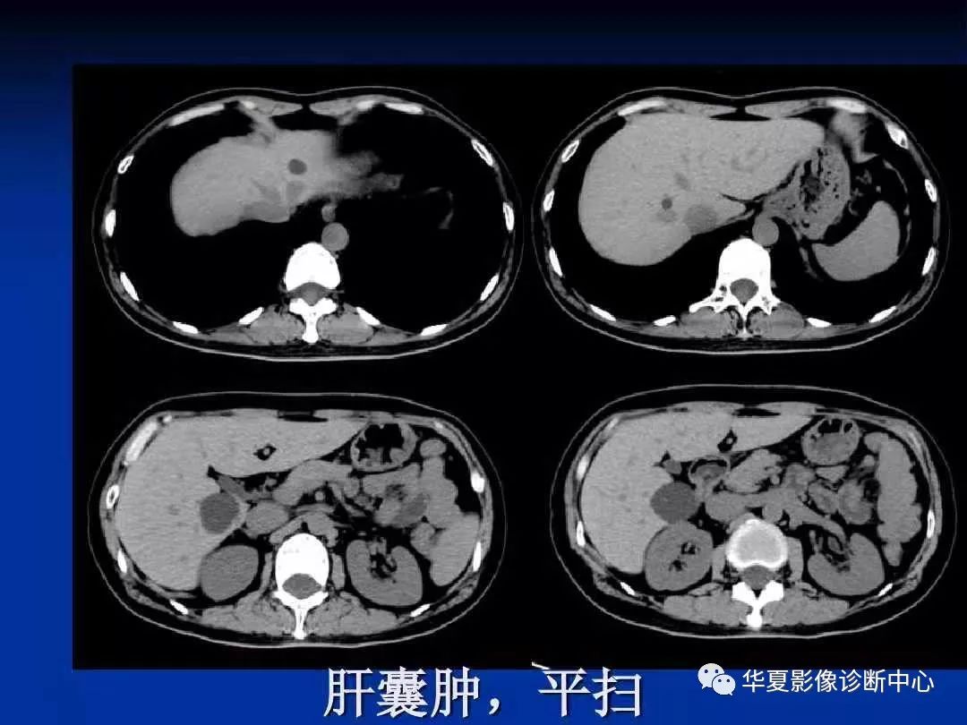 多囊肝和肝内多发囊肿一样吗