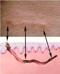 螨虫竟然在皮肤上做这种事