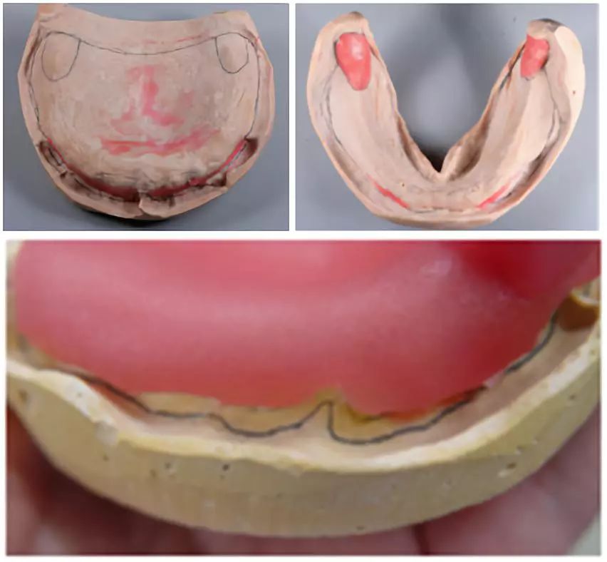 关于全口义齿印模及颌位记录的知识点徐小川医师