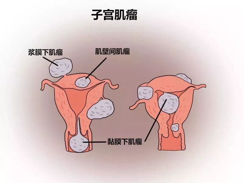 避之不及的妇科病,你真的了解吗?