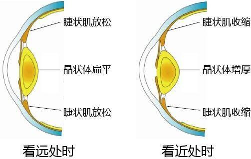 眼睛近视的原理_佩戴周边离焦镜片是否能有效控制度数