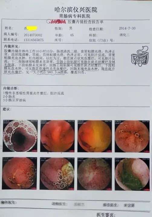 康复案例:克罗恩病改善的用户反馈