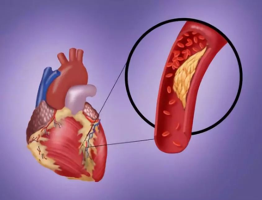胸痛不一定是冠心病!关于心脏病的12个知识