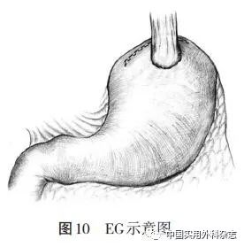 指南与共识完全腹腔镜胃癌手术消化道重建专家共识及手术操作指南2018