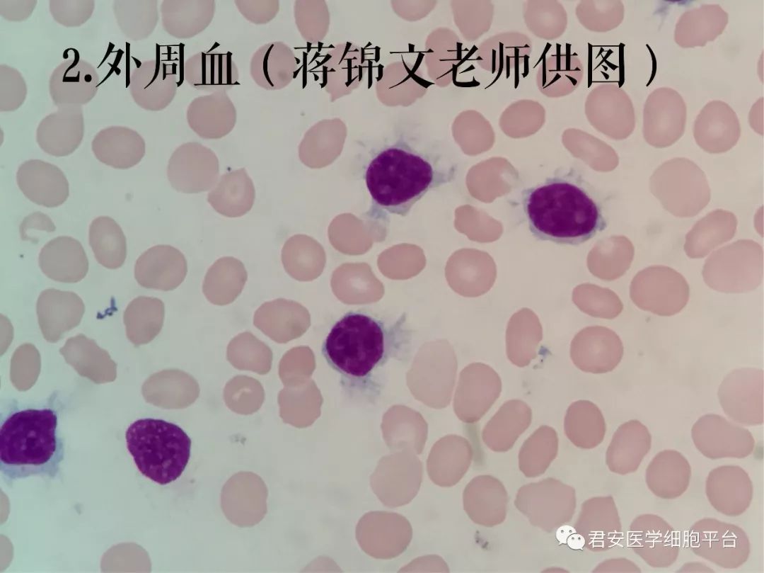 知识库 正文  (4)涂抹细胞或篮状细胞,见于淋巴细胞白血病.