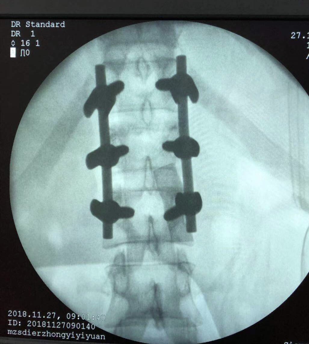 腰椎后路肌间隙入路钉棒系统固定治疗腰椎爆裂骨折