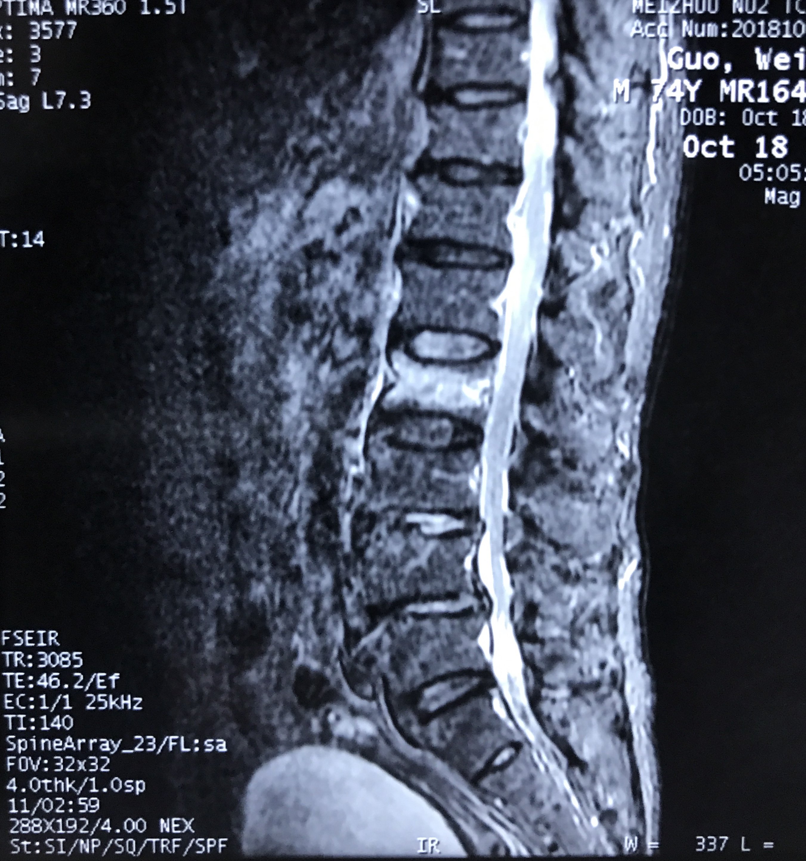 脊柱 | 弥漫性特发性骨质增生症（DISH）-MSK4_关节