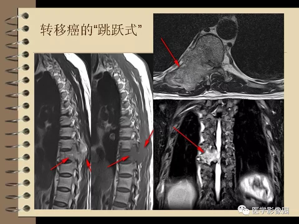 脊柱原发性恶心淋巴瘤的影像诊断 | 读片专栏