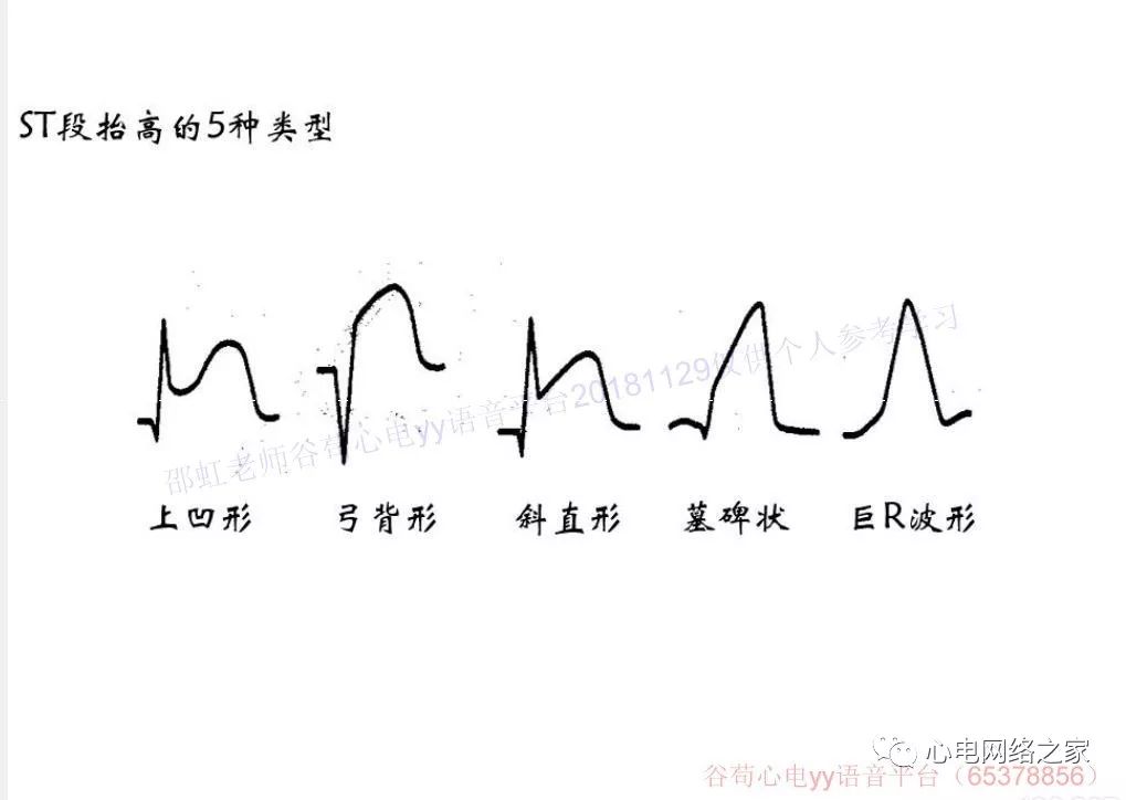 11.29 邵虹老师-急性心肌梗死心电图诊断