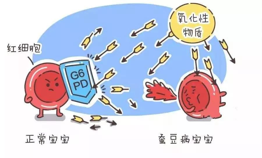 得了蚕豆病后会出现急性溶血,黄疸,严重贫血,面色苍白,小便呈酱油色