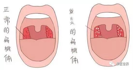 腮腺炎,扁桃体炎都是常见病,儿童尤其多发.