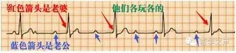 三度房室传导阻滞