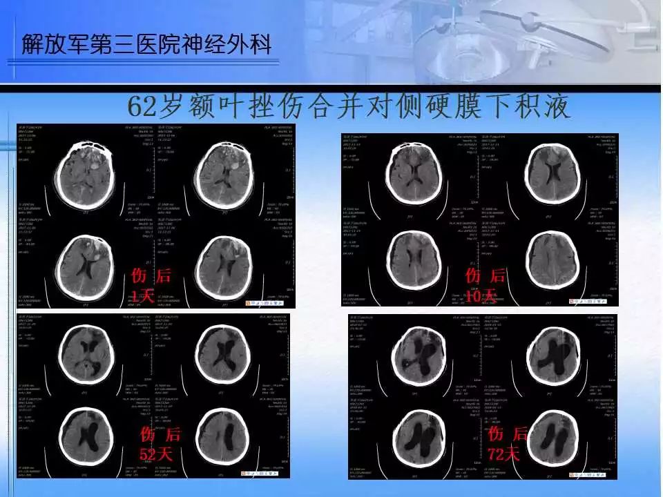 双额叶脑挫裂伤诊治中的一点思考丨 颅脑创伤-神经重症病例周刊(94期)