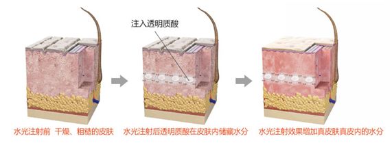 張雨綺拉皮、應采兒打肉毒素……明星都在做的醫美靠譜嗎？ 娛樂 第9張