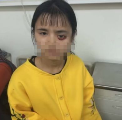 只因小时候拔了颗蛀牙,16岁女孩眼珠整个掉下来.