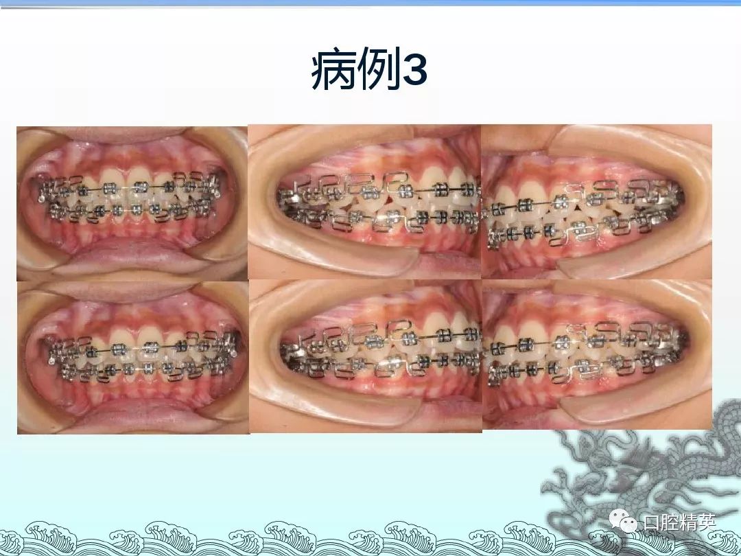 牙合畸形的早期矫治