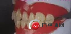 全口排牙方法图例