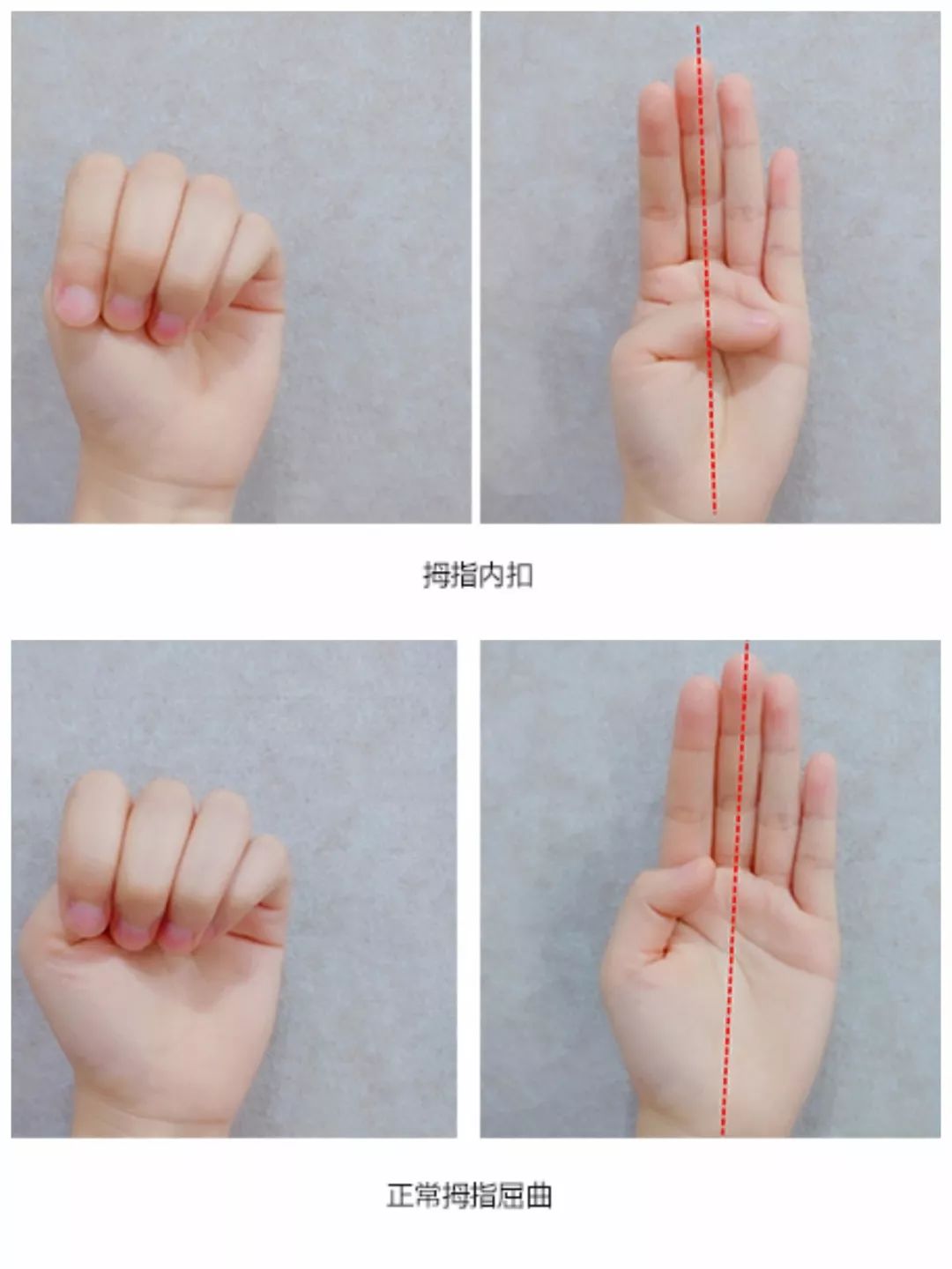 宝宝手掌张开时,拇指位置超过手掌中线,并紧贴向手掌,也叫皮层拇指征