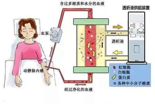 血液透析与血液滤过的区别