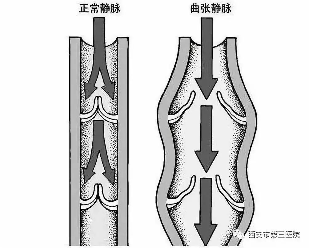 下肢静脉曲张示意图