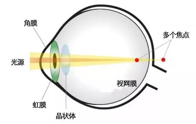 它是屈光不正