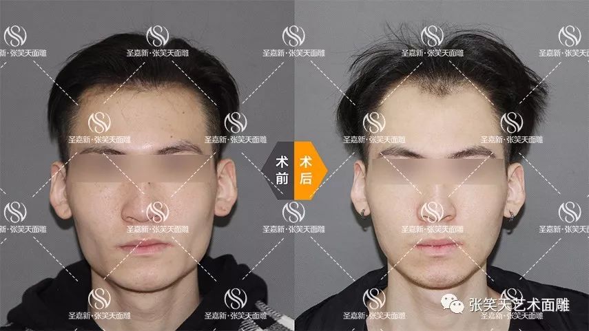 男人也可以整形下颌角截骨瘦脸真人案例