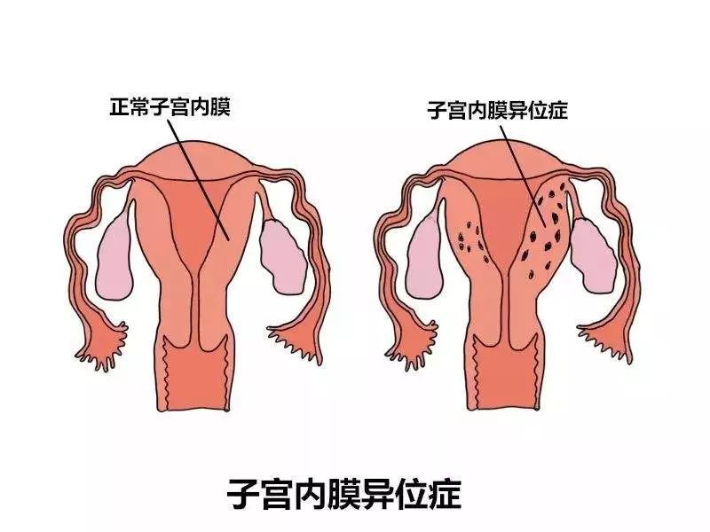 为什么子宫内膜异位症,是你怀孕路上的"杀手"