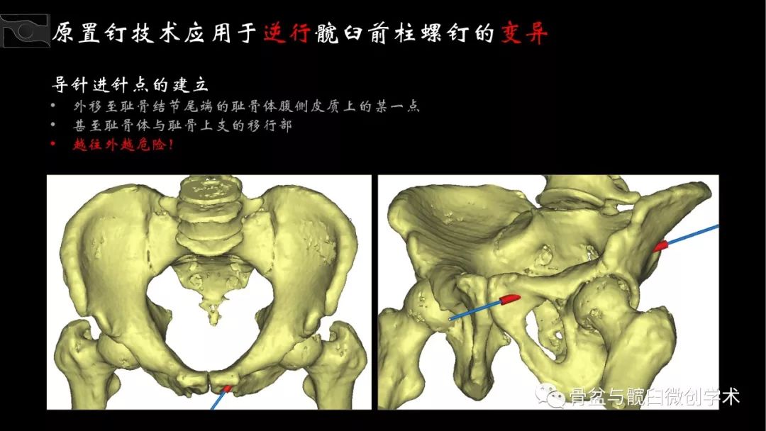 caos第四届术者荣耀参赛视频——改良的经皮逆行耻骨上支/髋臼前柱