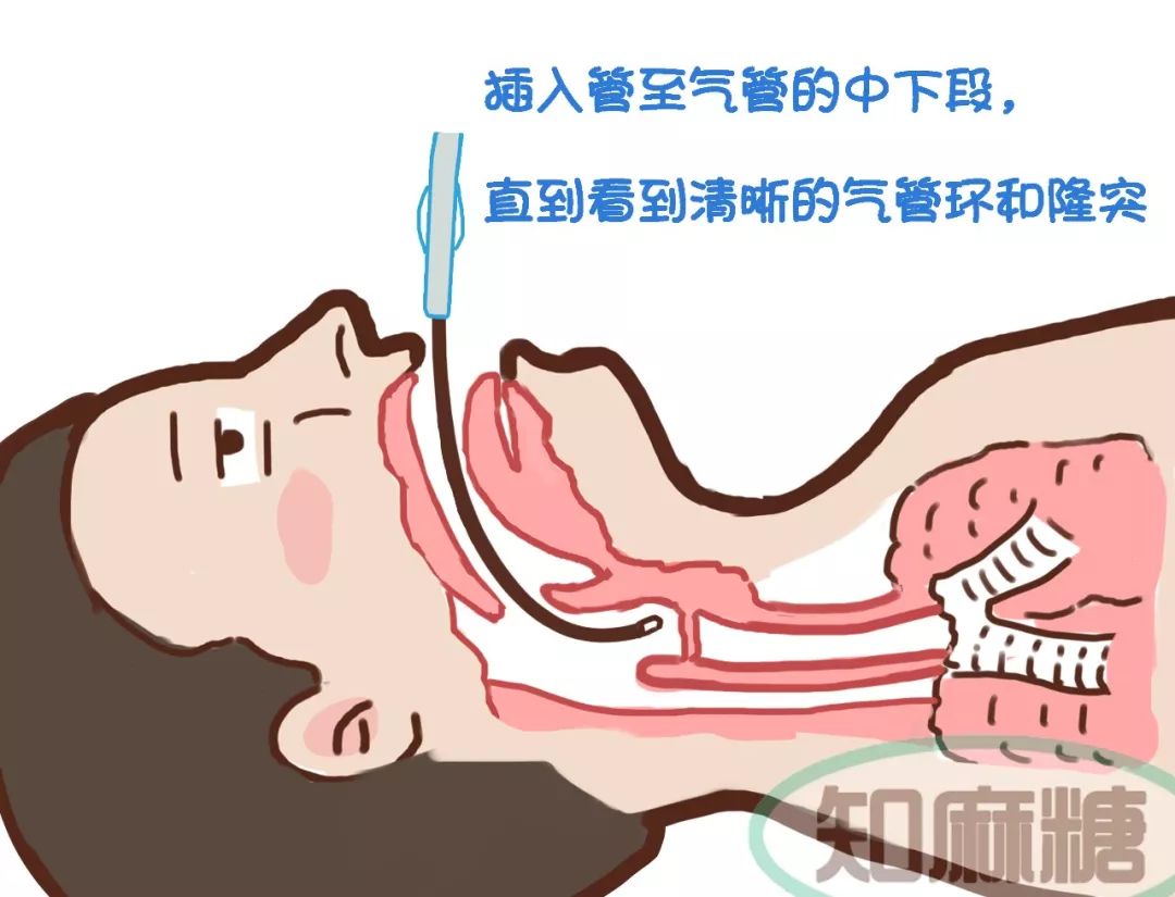 导读:沿插入管将气管导管伴随微旋转动作推进到气管内合适的位置并固