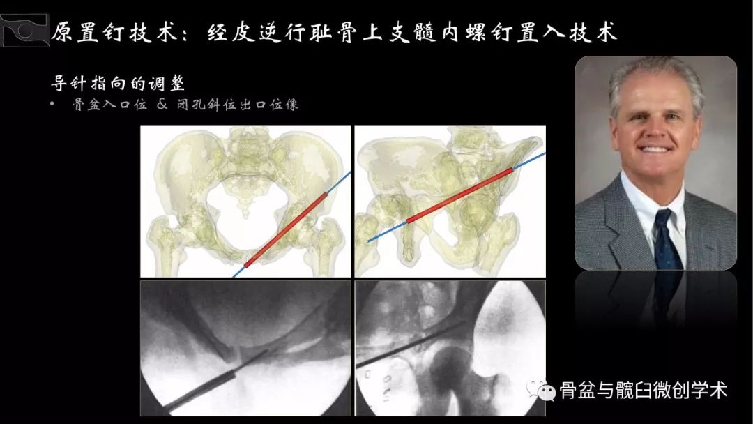 导针指向的调整依赖骨盆入口位及闭孔斜位出口位像.