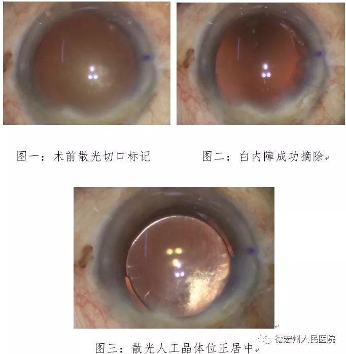 以往白内障患者矫正散光的主要方法包括术后戴镜(包括角膜接触镜等)