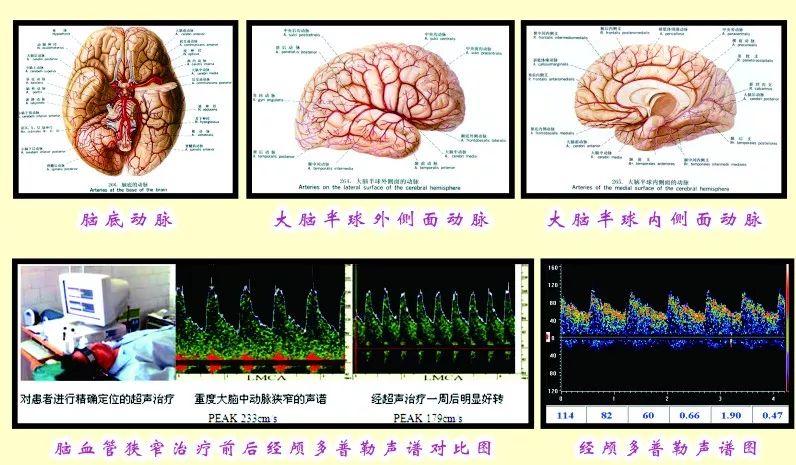 经颅多普勒(tcd),就是人们熟知的脑血流图检查,它借助脉冲多普勒技术