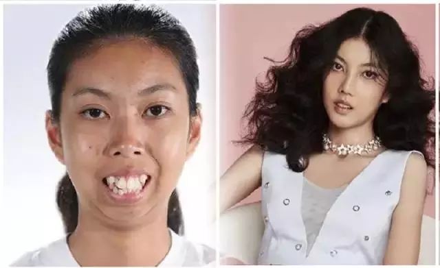 早前报道过 19岁泰国妹因参加了泰国选丑节目后爆红 只是做了牙齿矫正