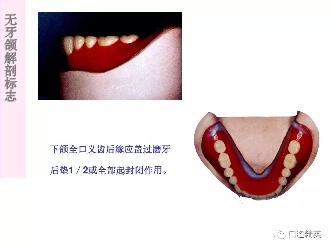 无牙颌解剖标志