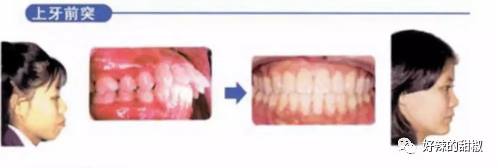 单纯牙列拥挤加牙齿倾斜度过大,通过拔牙 戴牙套,推动牙槽骨重建就