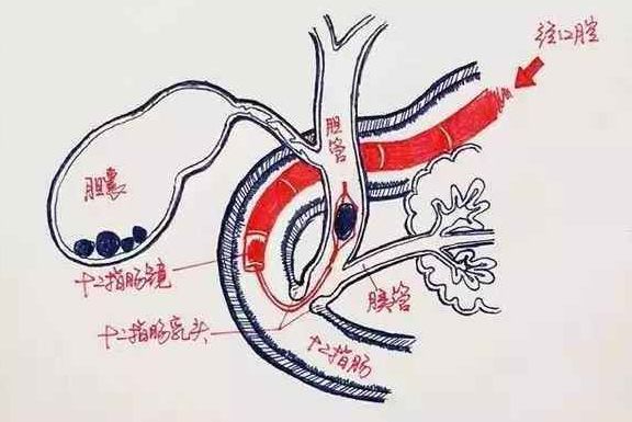 ercp-胆道健康的守护神