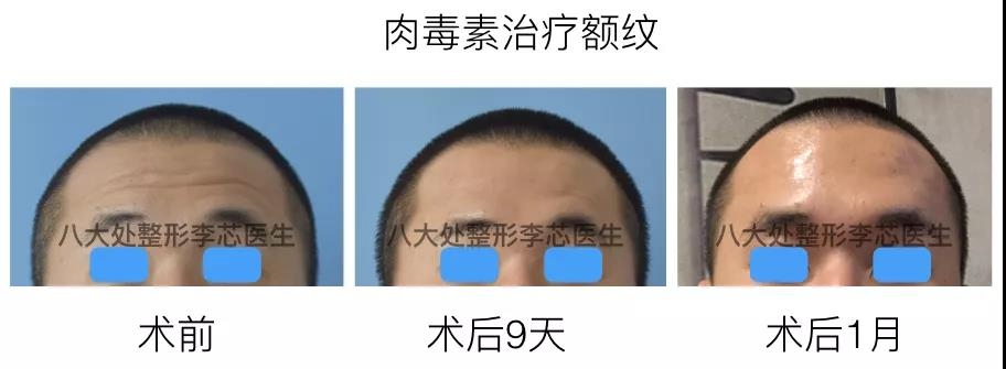 案例分析 普通人去除额线被称为"去除抬头纹".