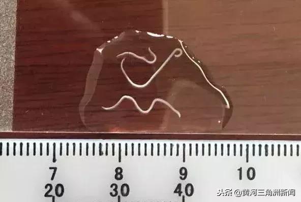 (从患儿眼中取出的结膜吸吮线虫) 后经医院微生物室鉴定为结膜吸吮