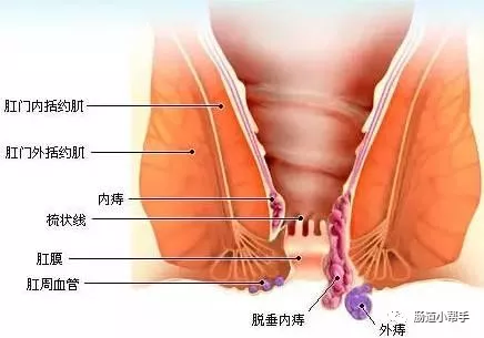 痔疮流水怎么办