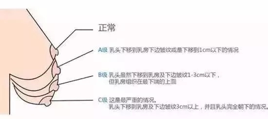 乳房下垂?祝正超老师告诉你原因