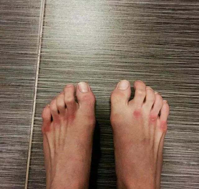 有一位在练习芭蕾舞的舞者,在朋友圈里,发了自己的脚的图片