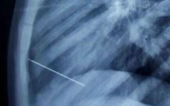 亳州一2岁男童被针扎入心脏,医生开胸取出4厘米绣花针