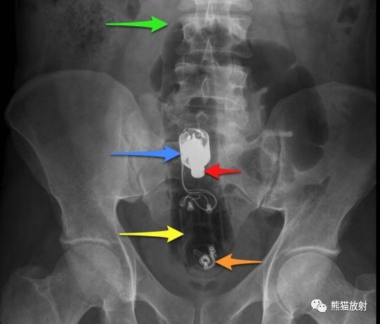 直肠异物丨影像表现震惊了