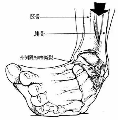 大腿内侧扭到筋怎么办