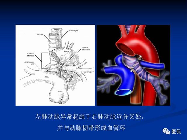 肺动脉吊带的影像学表现 医学影像经典ppt