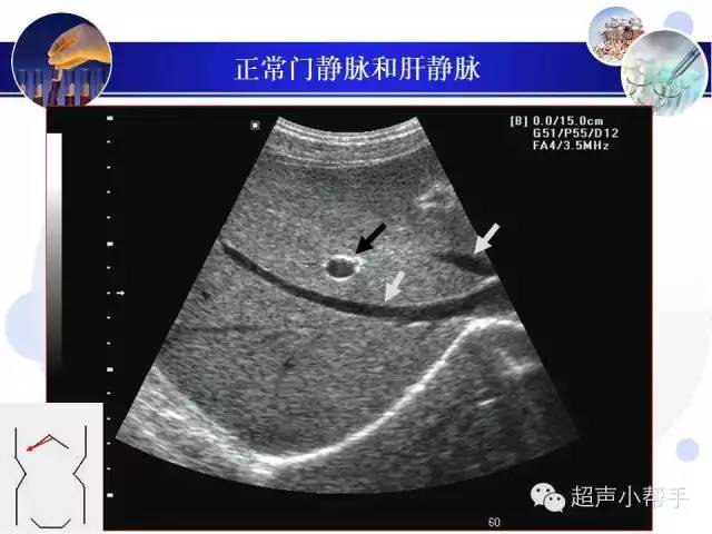 超声微课堂肝叶与肝段的超声图解